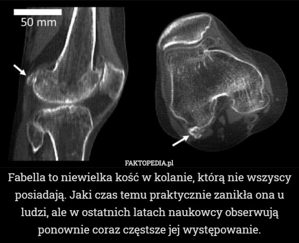 Fabella to niewielka kość w kolanie, którą nie wszyscy posiadają. Jaki czas temu praktycznie zanikła ona u ludzi, ale w ostatnich latach naukowcy obserwują ponownie coraz częstsze jej występowanie. 