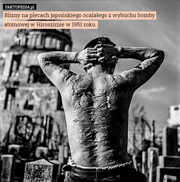 Blizny na plecach japońskiego ocalałego z wybuchu bomby atomowej w Hiroszimie w 1951 roku. 