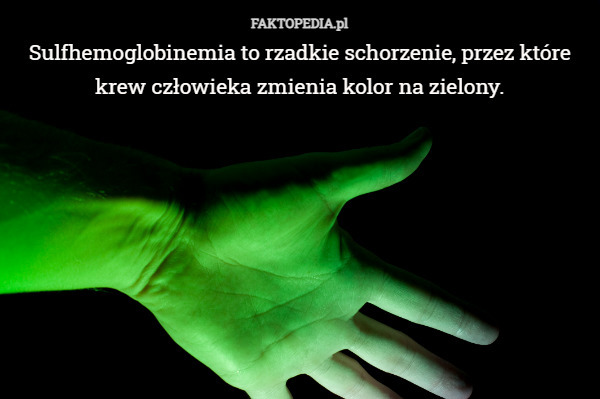 Sulfhemoglobinemia to rzadkie schorzenie, przez które krew człowieka zmienia kolor na zielony. 