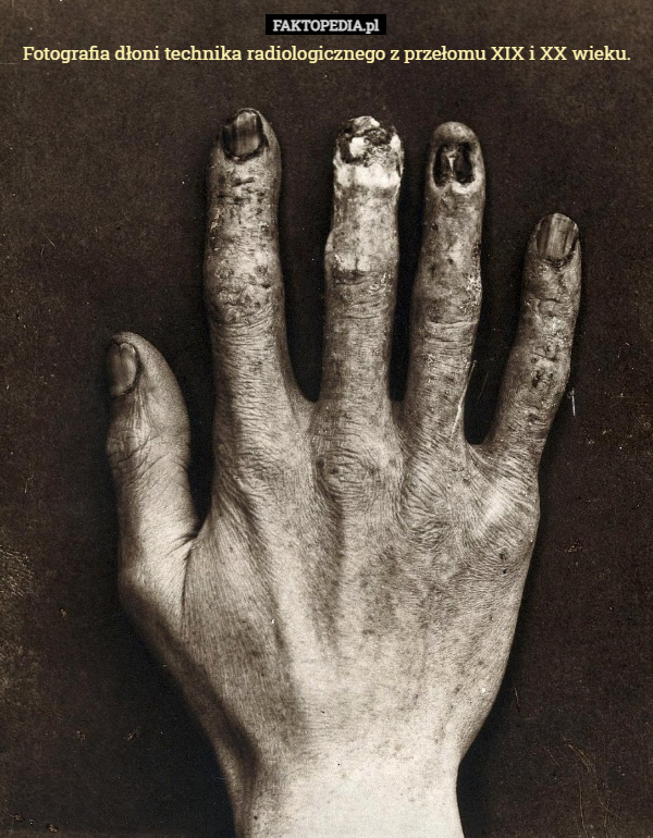 Fotografia dłoni technika radiologicznego z przełomu XIX i XX wieku. 