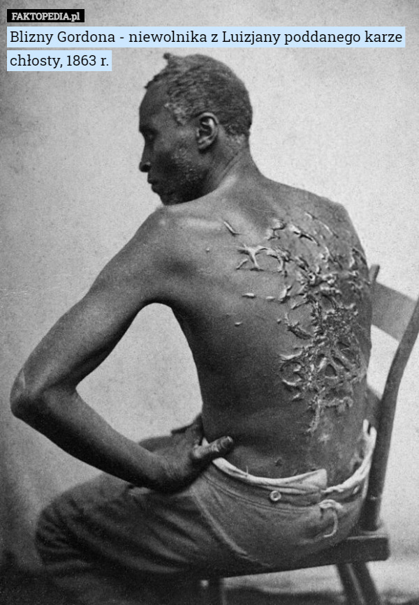 Blizny Gordona - niewolnika z Luizjany poddanego karze chłosty, 1863 r. 
