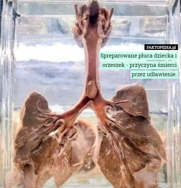 Spreparowane płuca dziecka i orzeszek - przyczyna śmierci przez udławienie. 