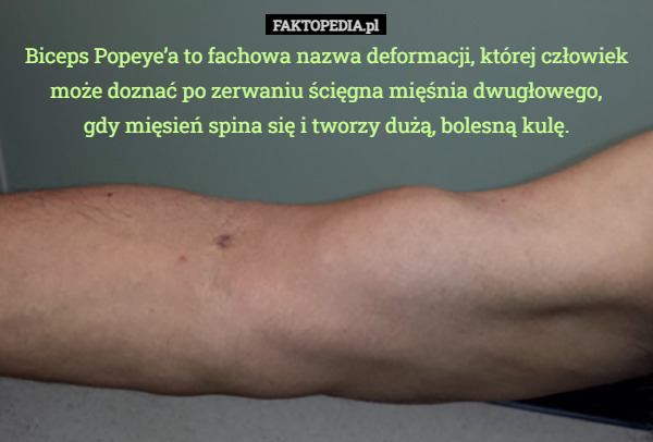 Biceps Popeye’a to fachowa nazwa deformacji, której człowiek może doznać po zerwaniu ścięgna mięśnia dwugłowego,
gdy mięsień spina się i tworzy dużą, bolesną kulę. 