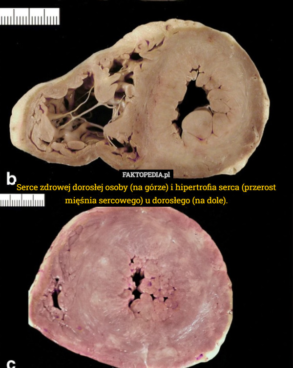 Serce zdrowej dorosłej osoby (na górze) i hipertrofia serca (przerost mięśnia sercowego) u dorosłego (na dole). 