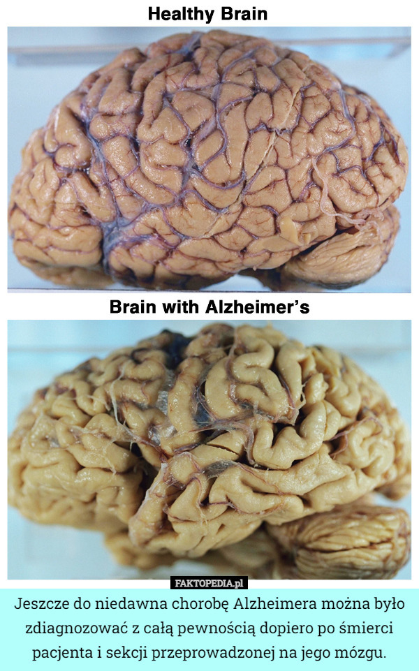 Jeszcze do niedawna chorobę Alzheimera można było zdiagnozować z całą pewnością dopiero po śmierci pacjenta i sekcji przeprowadzonej na jego mózgu. 