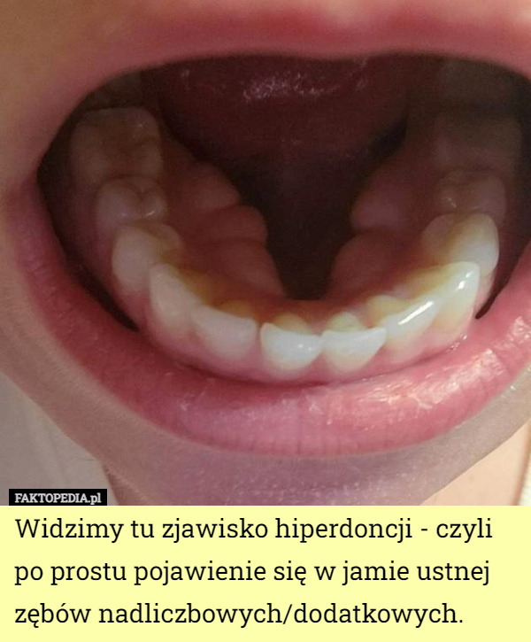 Widzimy tu zjawisko hiperdoncji - czyli po prostu pojawienie się w jamie ustnej zębów nadliczbowych/dodatkowych. 