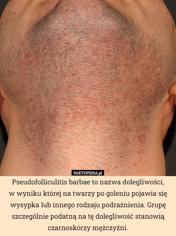Pseudofolliculitis barbae to nazwa dolegliwości,
w wyniku której na twarzy po goleniu pojawia się wysypka lub innego rodzaju podrażnienia. Grupę szczególnie podatną na tę dolegliwość stanowią czarnoskórzy mężczyźni. 