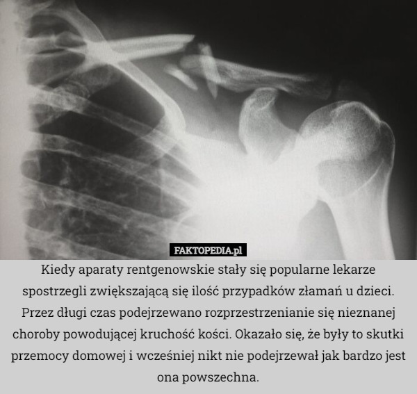 Kiedy aparaty rentgenowskie stały się popularne lekarze spostrzegli zwiększającą się ilość przypadków złamań u dzieci. Przez długi czas podejrzewano rozprzestrzenianie się nieznanej choroby powodującej kruchość kości. Okazało się, że były to skutki przemocy domowej i wcześniej nikt nie podejrzewał jak bardzo jest ona powszechna. 