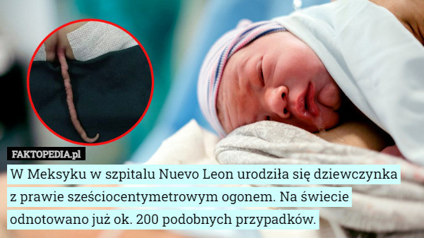 W Meksyku w szpitalu Nuevo Leon urodziła się dziewczynka
 z prawie sześciocentymetrowym ogonem. Na świecie odnotowano już ok. 200 podobnych przypadków. 
