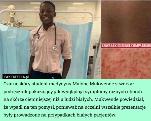 Czarnoskóry student medycyny Malone Mukwende stworzył podręcznik pokazujący jak wyglądają symptomy różnych chorób na skórze ciemniejszej niż u ludzi białych. Mukwende powiedział, że wpadł na ten pomysł, ponieważ na uczelni wszelkie prezentacje były prowadzone na przypadkach białych pacjentów. 
