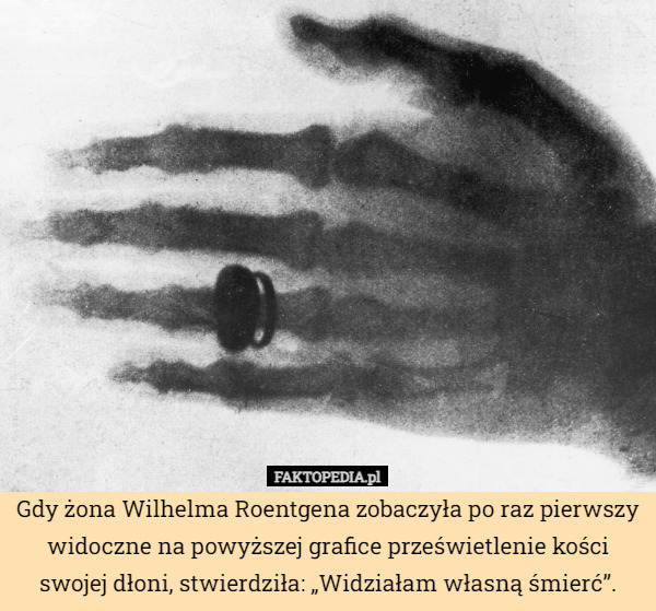 Gdy żona Wilhelma Roentgena zobaczyła po raz pierwszy widoczne na powyższej grafice prześwietlenie kości swojej dłoni, stwierdziła: „Widziałam własną śmierć”. 