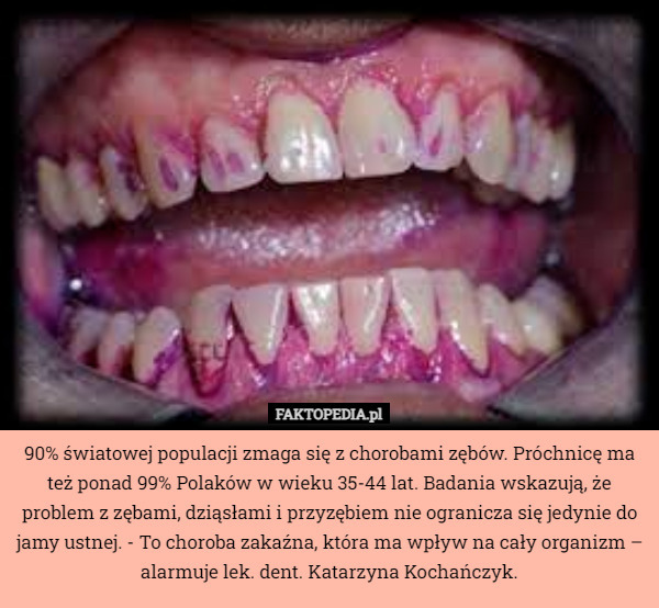 90% światowej populacji zmaga się z chorobami zębów. Próchnicę ma też ponad 99% Polaków w wieku 35-44 lat. Badania wskazują, że problem z zębami, dziąsłami i przyzębiem nie ogranicza się jedynie do jamy ustnej. - To choroba zakaźna, która ma wpływ na cały organizm – alarmuje lek. dent. Katarzyna Kochańczyk. 
