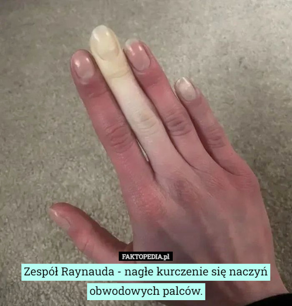 Zespół Raynauda - nagłe kurczenie się naczyń obwodowych palców. 